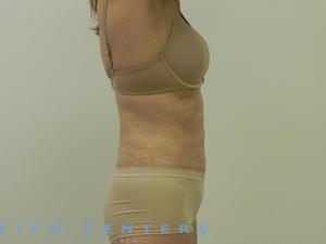 americanlipocenters_189.jpg